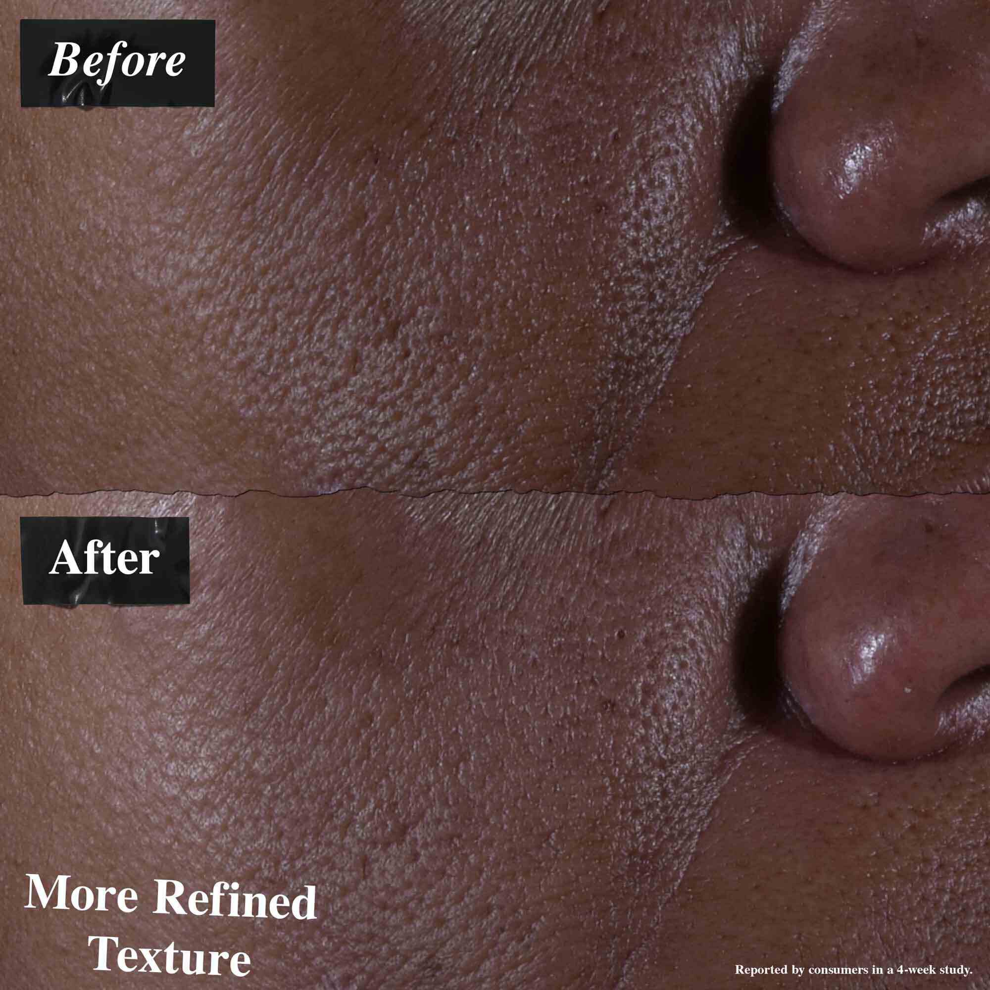 En før-og-etter-sammenligning som viser hud behandlet med Ultra Pure 9.8% Glycolic Acid Serum. "Før"-bildet viser ujevn tekstur, mens "etter"-bildet viser mer forfinet tekstur.