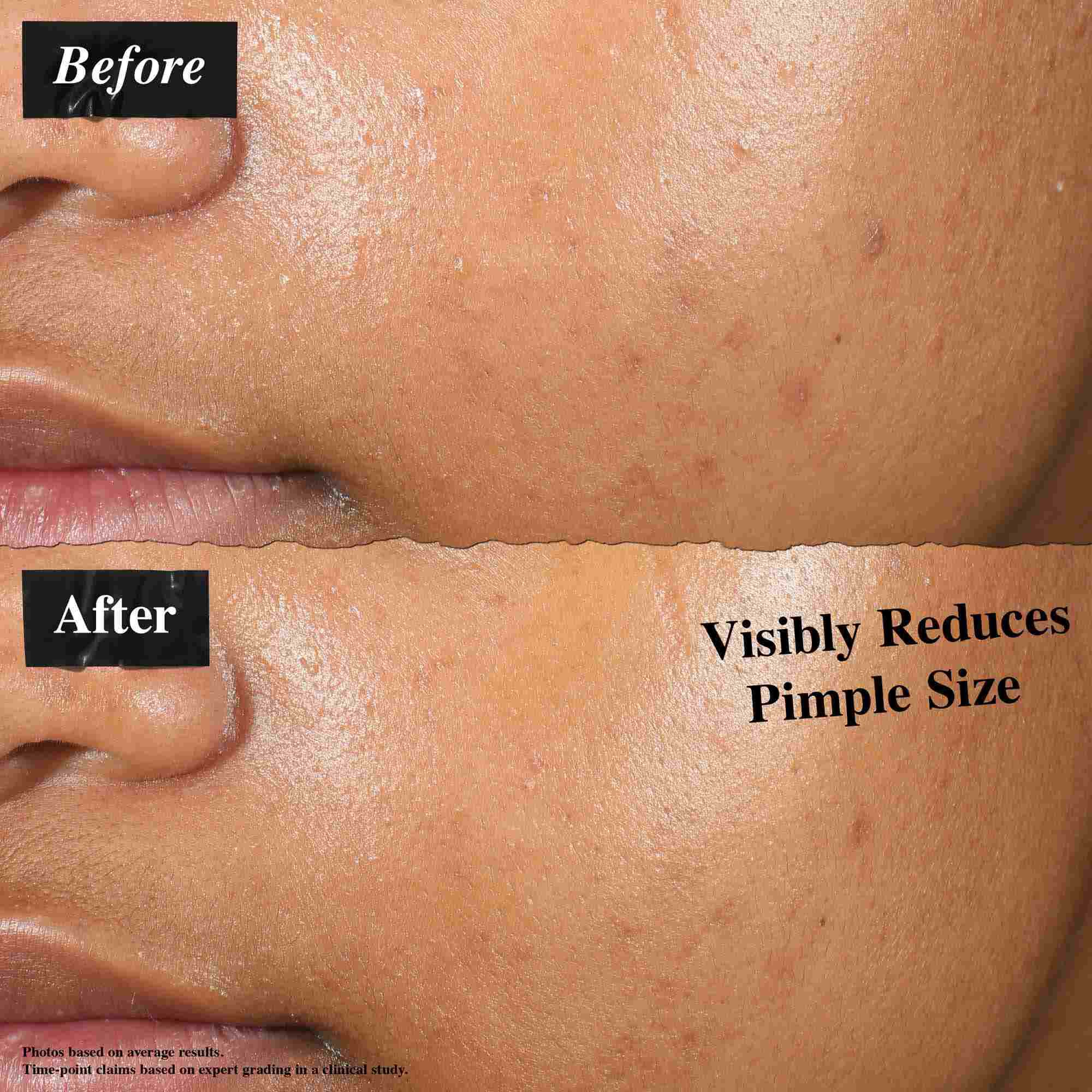 En før-og-etter-sammenligning som viser hud behandlet med Truly-Targeted Blemish-Clearing Solution. "Før"-bildet viser synlige kviser, mens "etter"-bildet viser redusert kvisestørrelse.